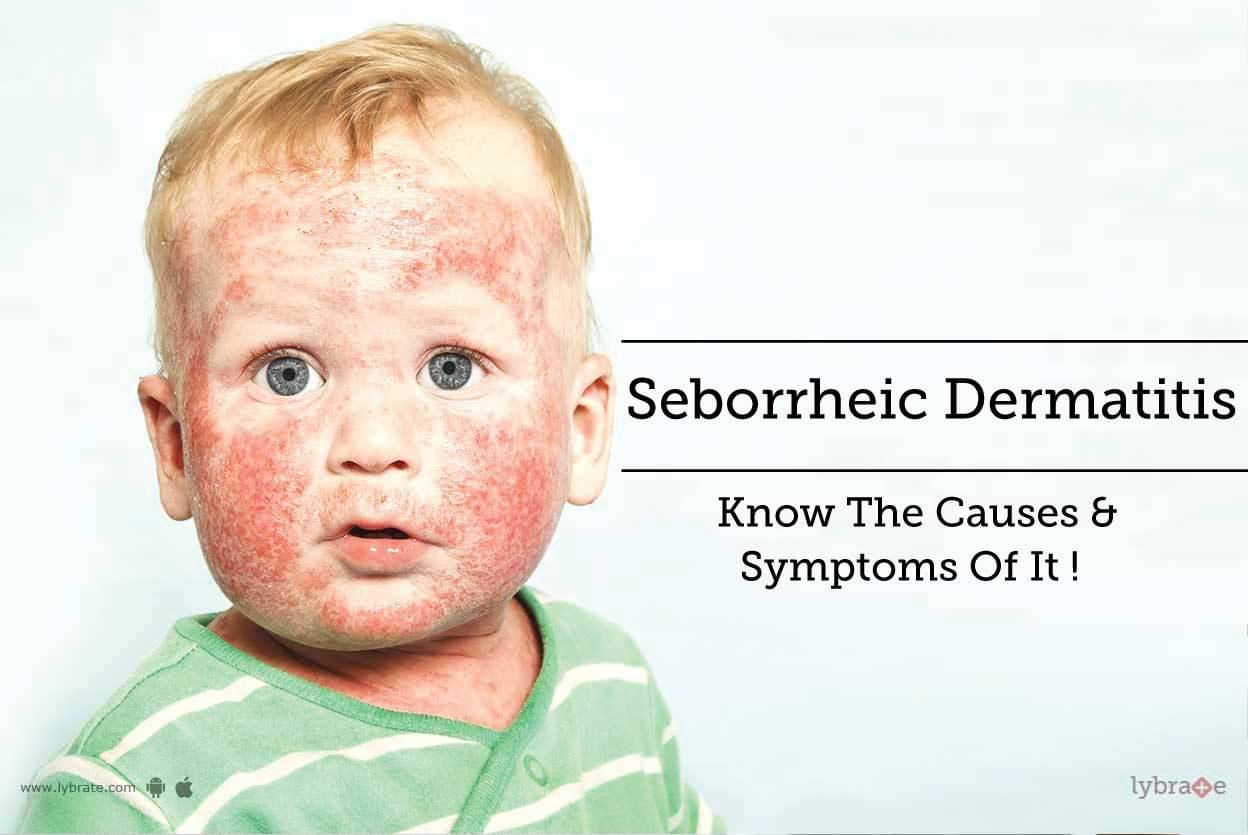 Seborrheic Dermatitis Know The Causes Symptoms Of It By Dr 10788 Hot