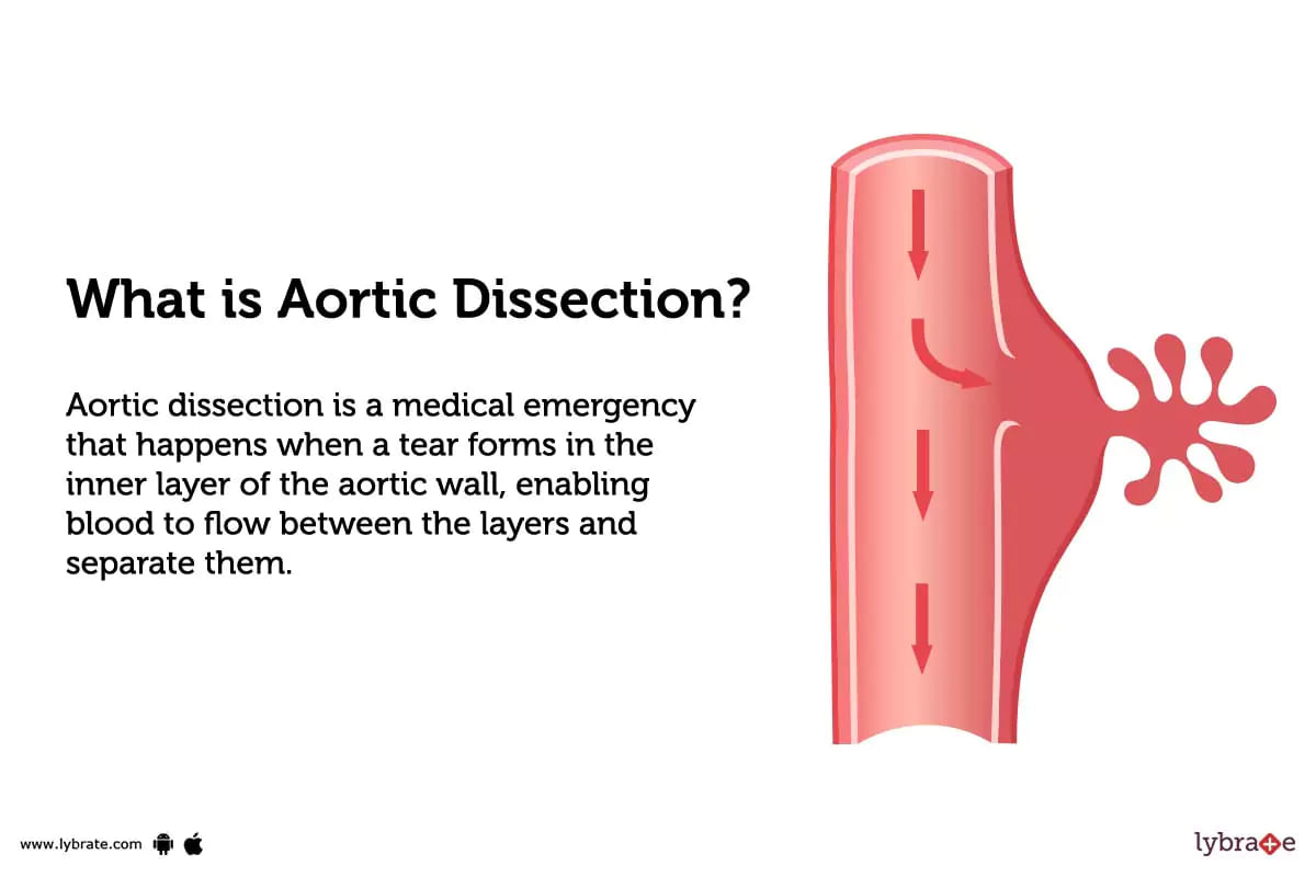 Aortic Dissection Causes Symptoms Treatment And Cost