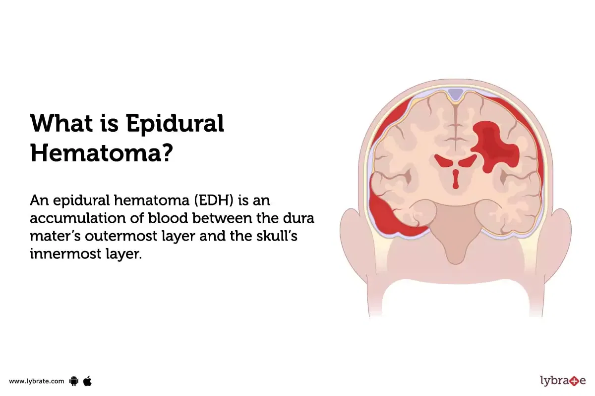 Epidural Hematoma Causes Symptoms Treatment And Cost