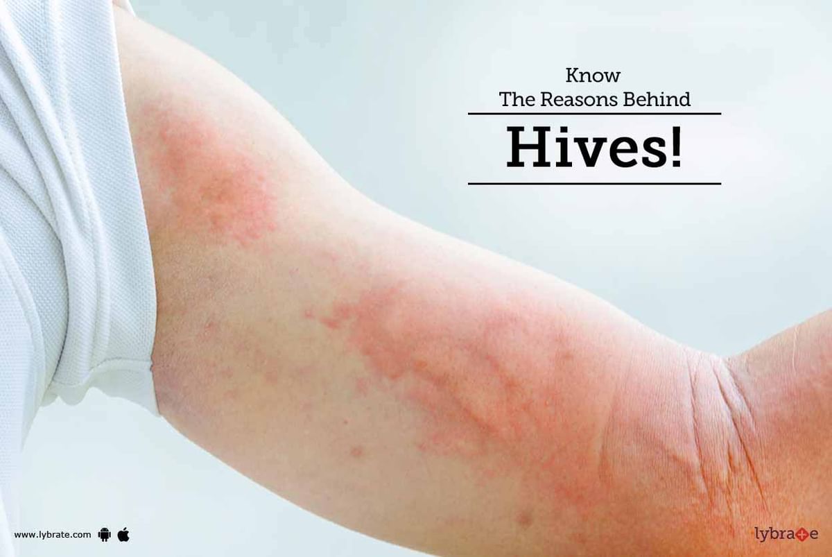 Know The Reasons Behind Hives By Cosmetica Skin Laser Hair