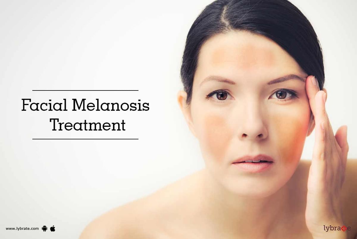 Facial Melanosis Treatment By Dr Sandeep Gupta The Dermatologist