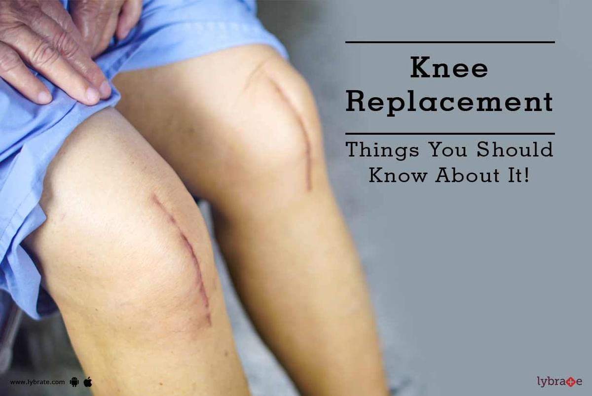 Knee Replacement Things You Should Know About It By Dr Arun Gupta