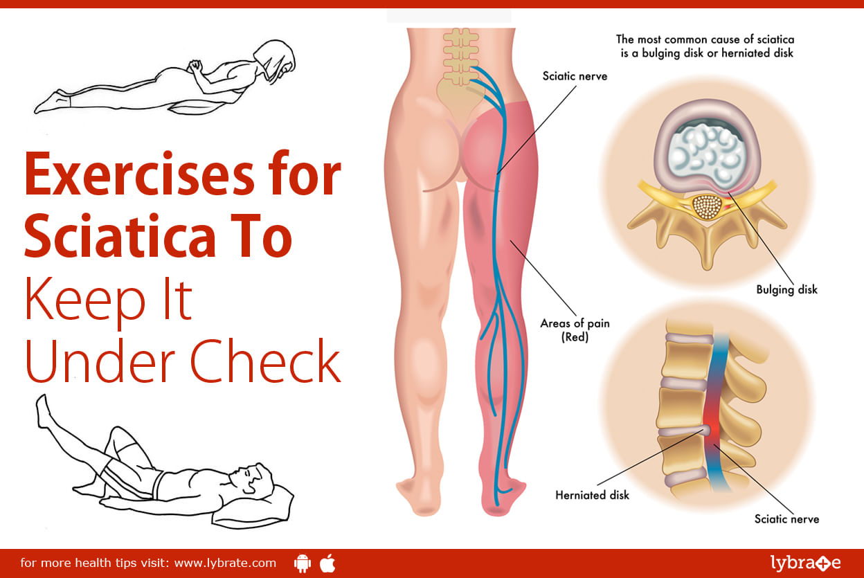 Sciatica anal burning