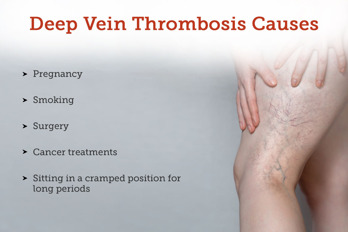 Deep Venous Thrombosis Dvt Causes Physio Treatments Off