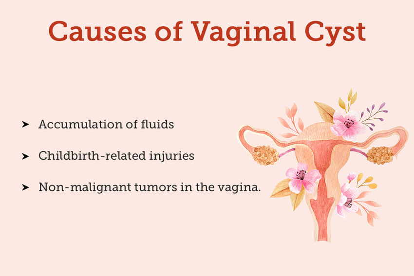 Vaginal Cyst Symptoms Causes Treatment And Cost