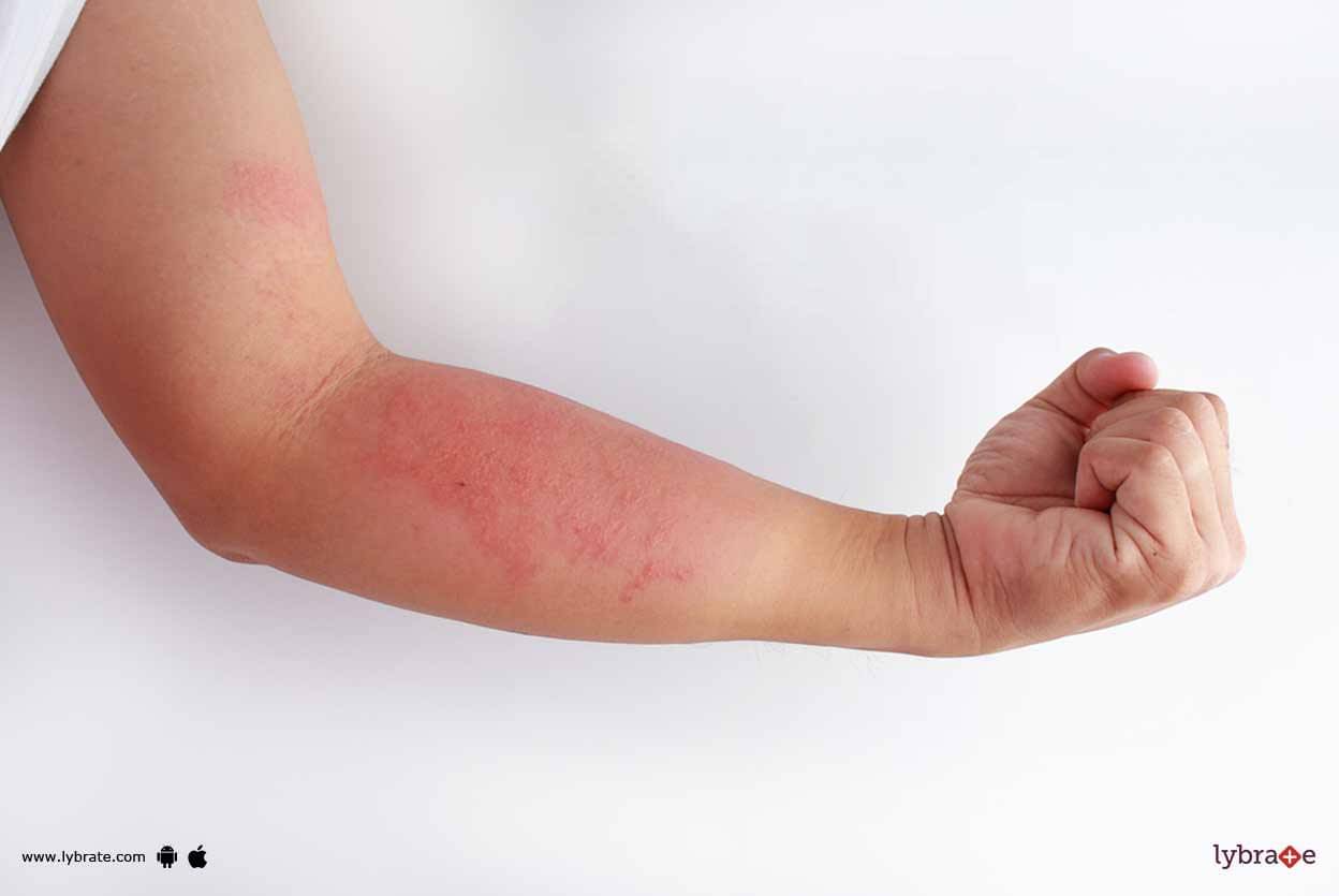 Eczema - How You Can Prevent Its Flare-ups? - By Dr. Nitin Jain | Lybrate