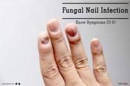 Fungal Nail Infection Know Symptoms Of It By Dr Nishant Jain 