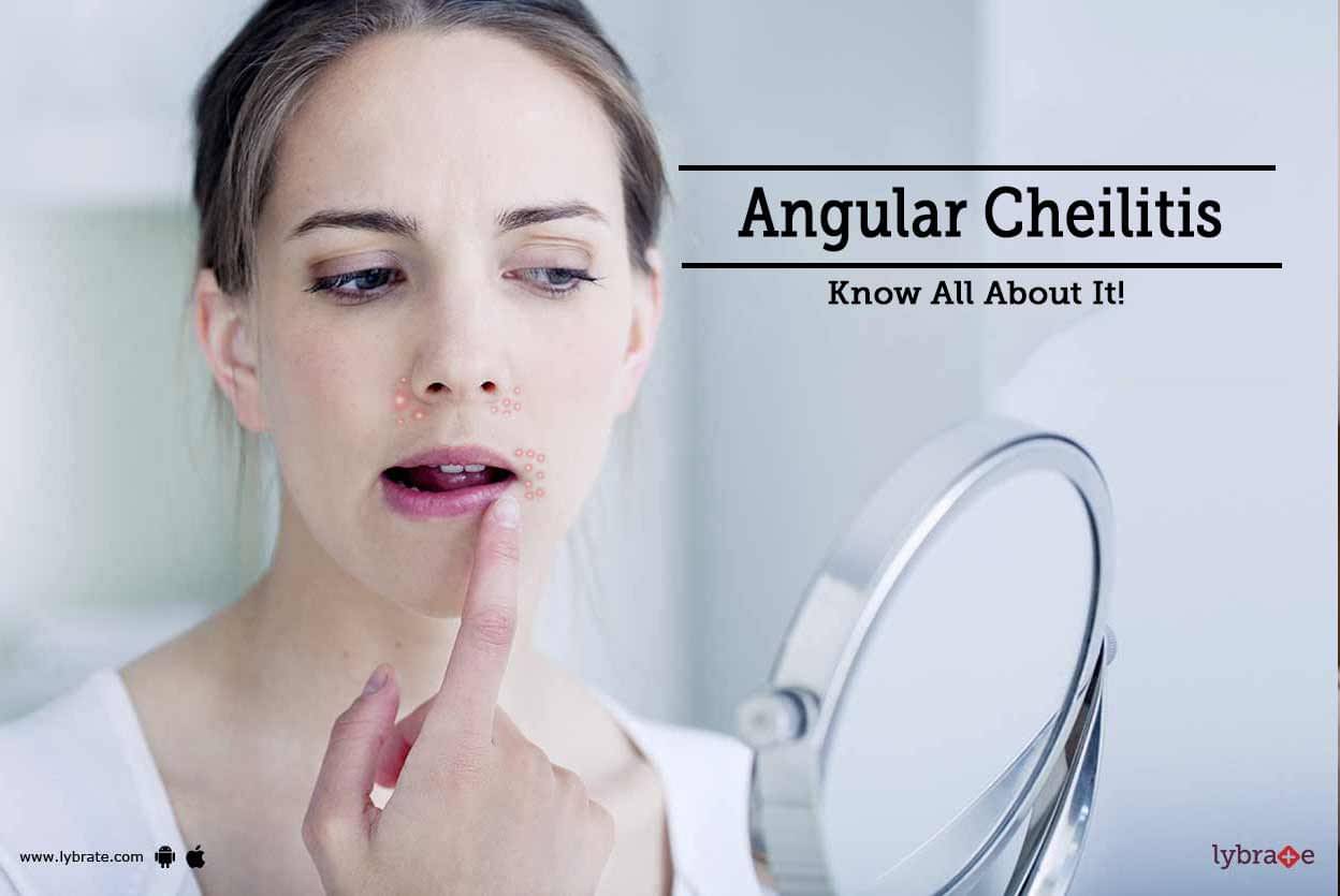 Angular Cheilitis Know All About It By Dr Radha Shah Lybrate