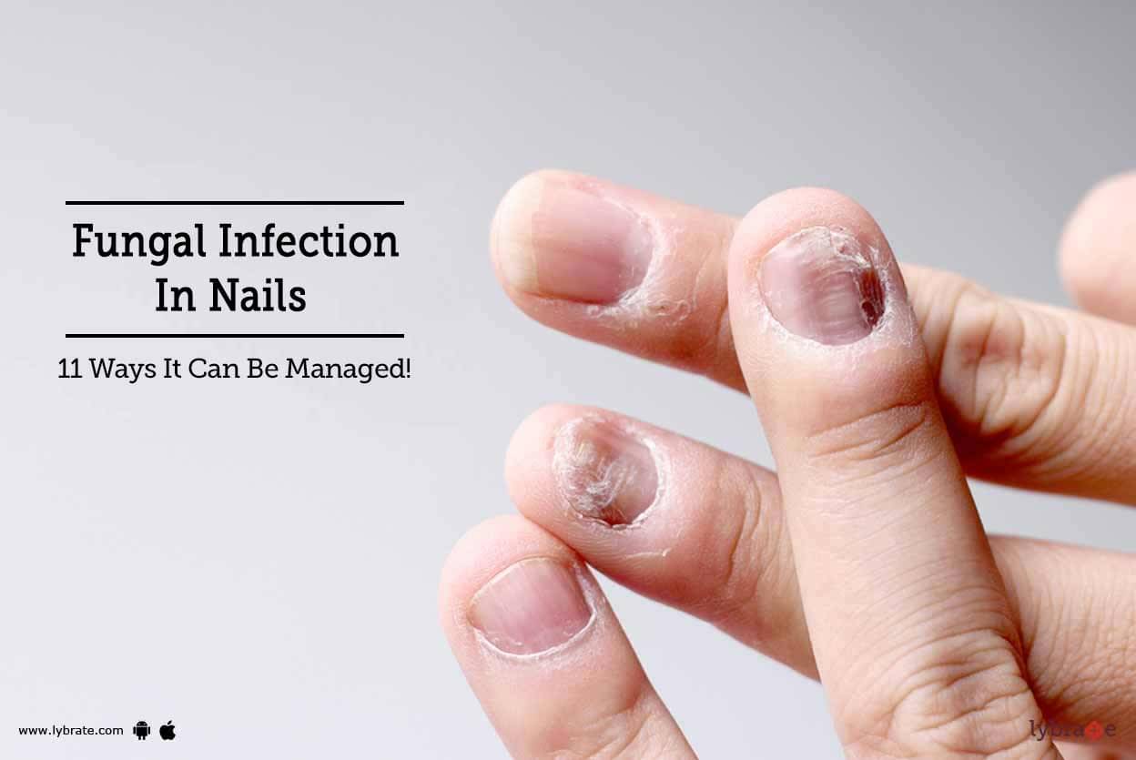 Fungal Infection In Nails - 11 Ways It Can Be Managed! - By Dr. Niraj ...