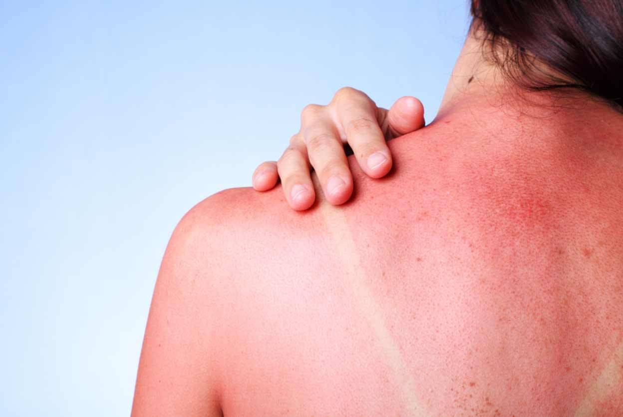 7-skin-problems-caused-due-to-sun-exposure-by-dr-rahul-balmiki