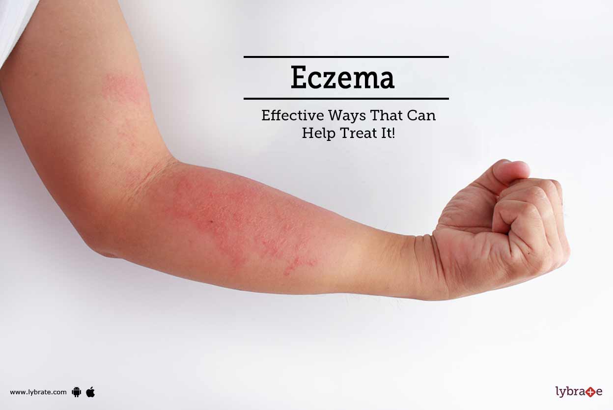 Eczema Effective Ways That Can Help Treat It! By Dr. Seema Yadav