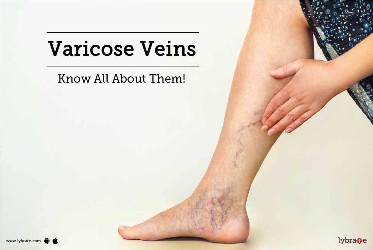 Varicose Veins - Know All About Them! - By Dr. Chandrakant Kamble | Lybrate