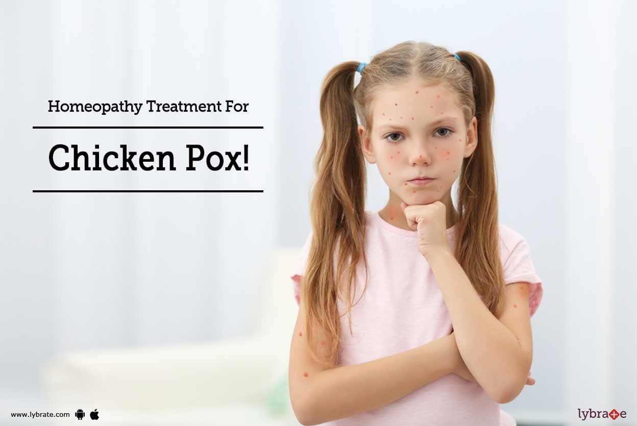 chicken pox treatment