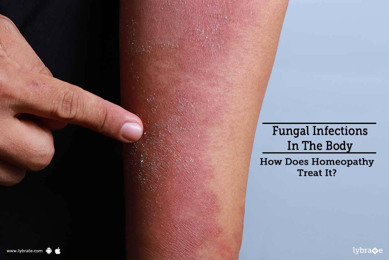 Fungal Infections In The Body How Does Homeopathy Treat It? By Dr