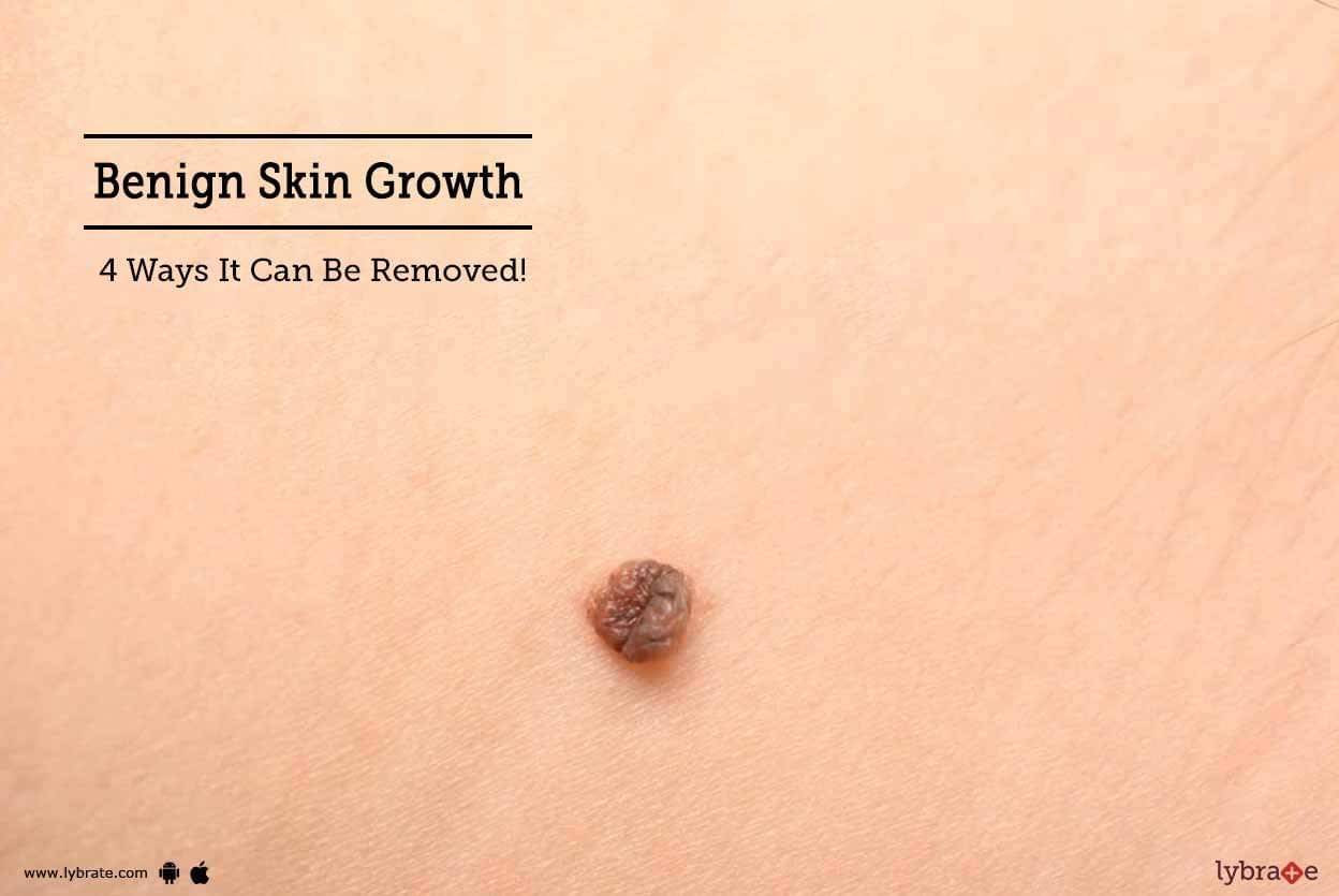 Benign Skin Growth - 4 Ways It Can Be Removed! - By Dr. Smita ...