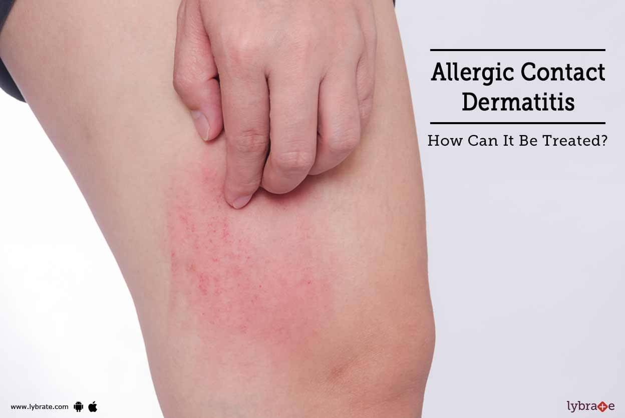Allergic Contact Dermatitis - How Can It Be Treated? - By 