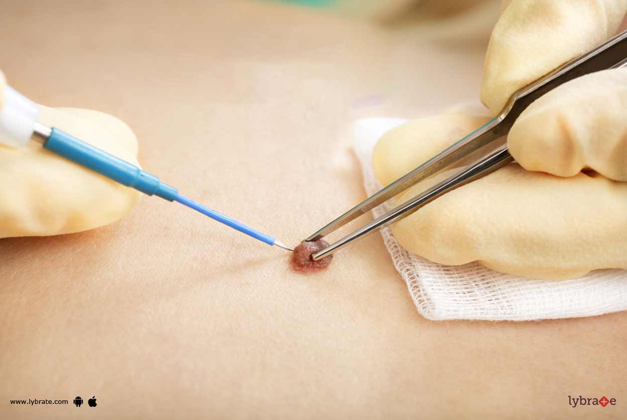 Moles & Nevus How Can Plastic Surgery Remove These? By Dr. Ramakant