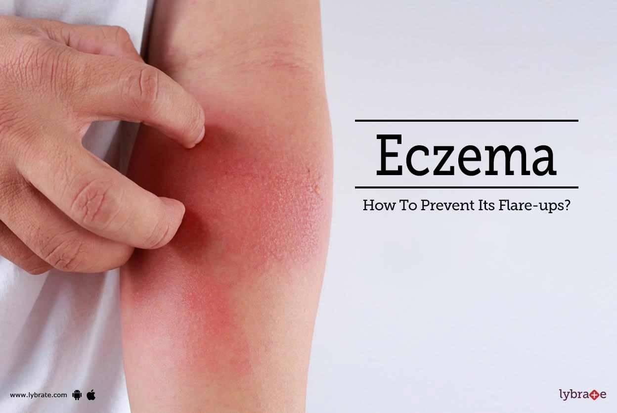 eczema-how-to-prevent-its-flare-ups-by-dr-nimesh-d-mehta-lybrate