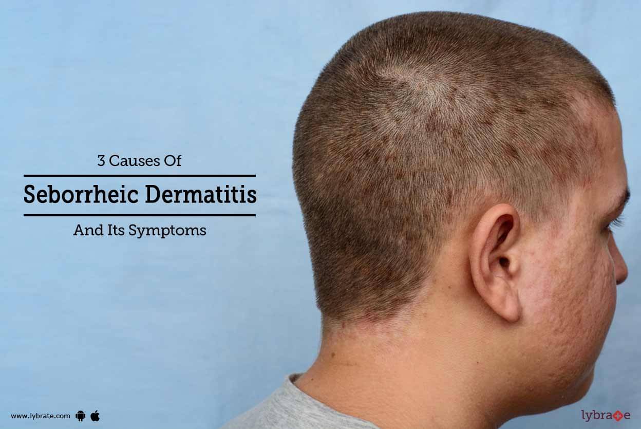 3 Causes Of Seborrheic Dermatitis And Its Symptoms By Dr Archit Aggarwal Lybrate