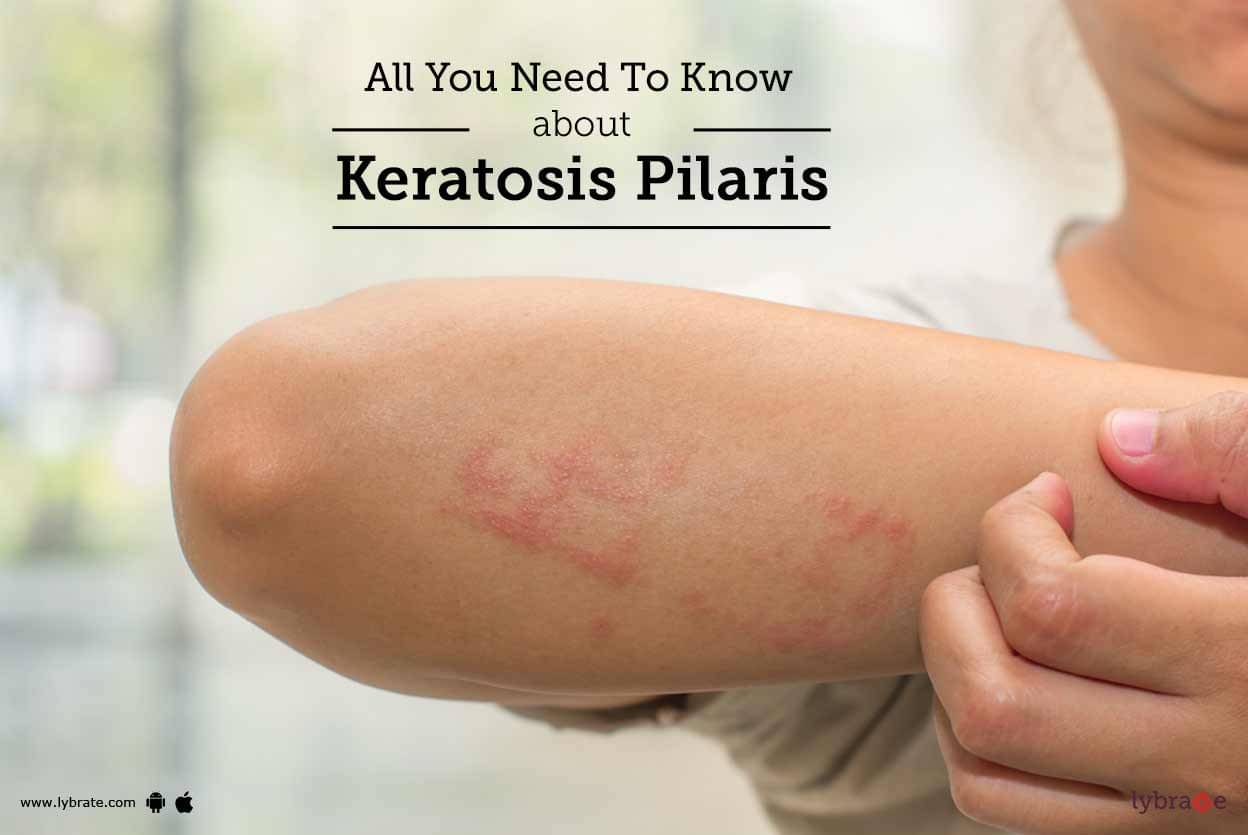 keratosis-pilaris-signs-causes-treatment-and-prevention-by-dr