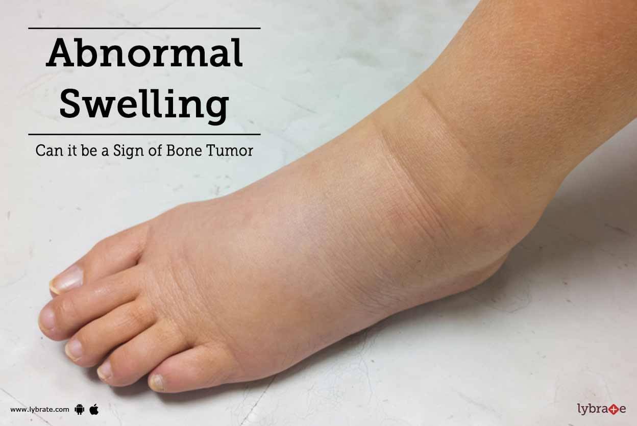 Signs Of Bone Cancer In The Foot : Symptoms of bone cancer / Bone metastasis occurs when cancer cells spread from their original site to a bone.