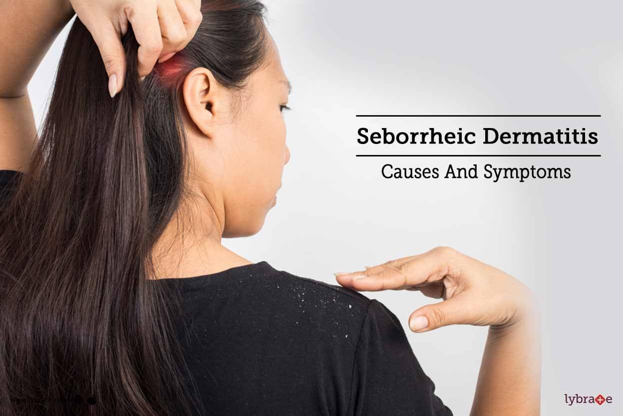 Seborrheic Dermatitis Causes And Symptoms By Dr Akhilendra Singh Lybrate