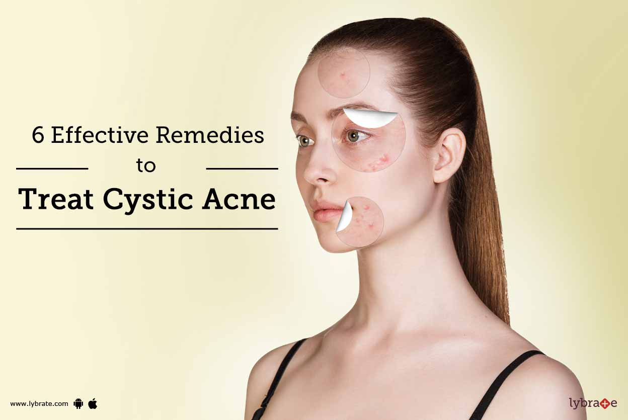 cystic acne remedy