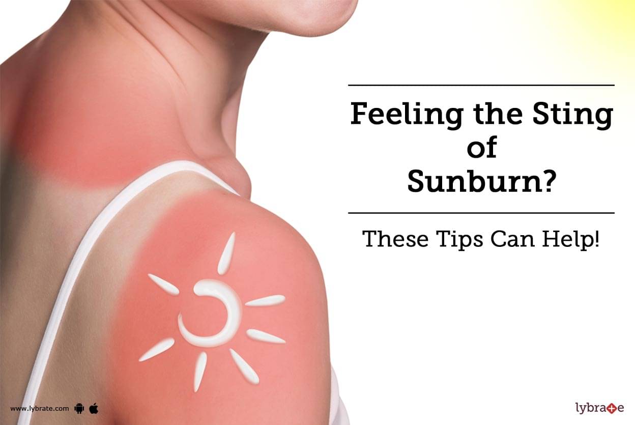 what takes out the sting in a sunburn