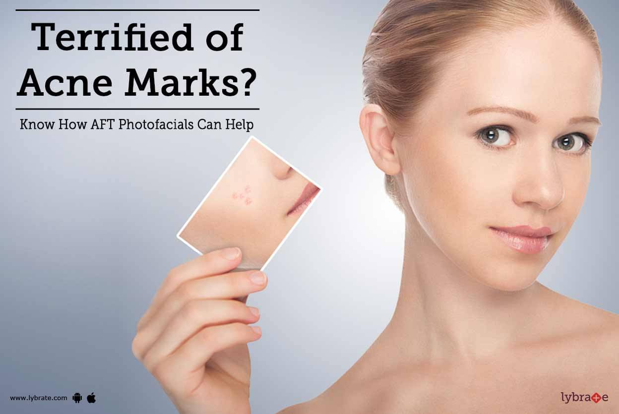 terrified-of-acne-marks-know-how-aft-photofacials-can-help-by-dr