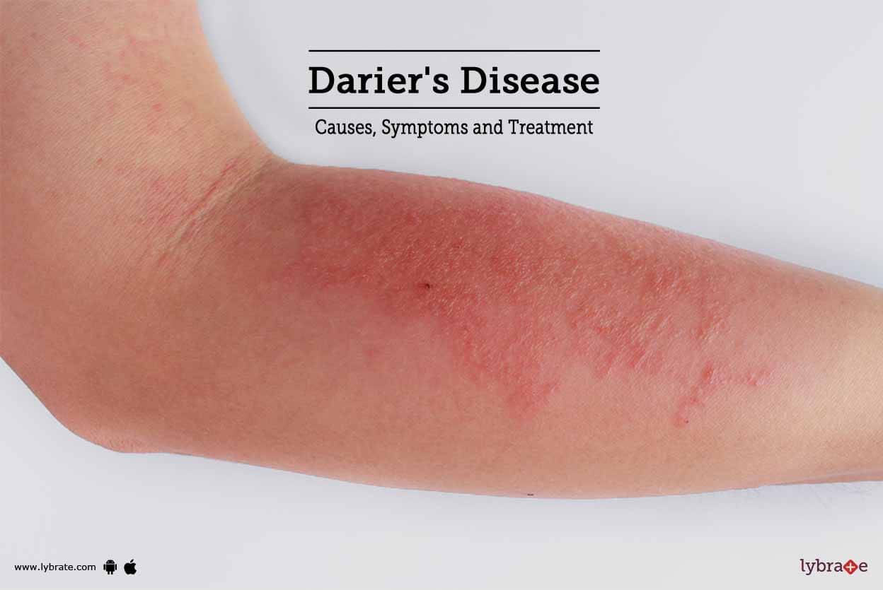 Darier's Disease: Causes, Symptoms and Treatment - By Dr. S. K. Kashyap ...