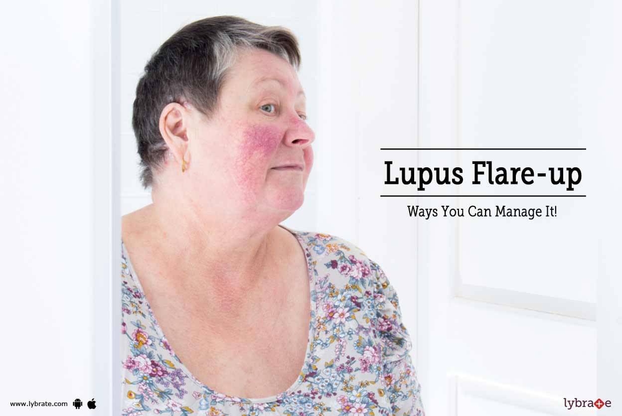 lupus flare up