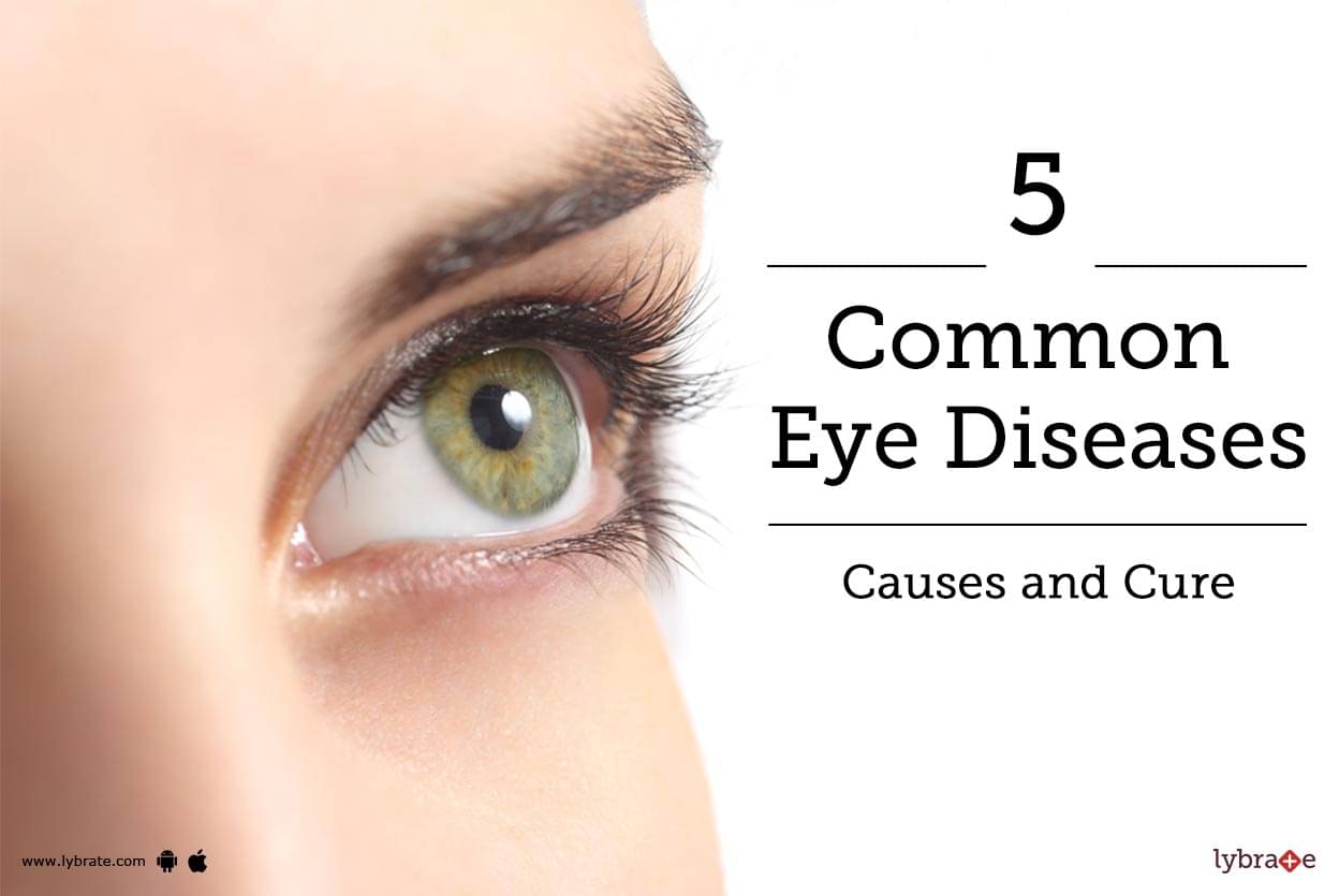 List Of Common Eye Diseases