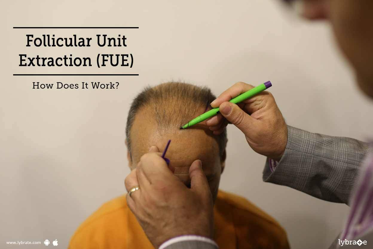 Follicular Unit Extraction (FUE): How Does It Work? - By Dr. Sumeet ...