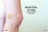 Blood Clots In Legs How Can They Be Prevented By Dr Vinod Nair 