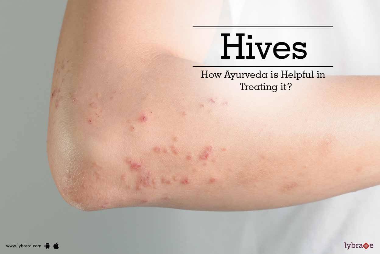 what-are-viral-hives-in-adults-what-is-viral-hives-treatment-quora