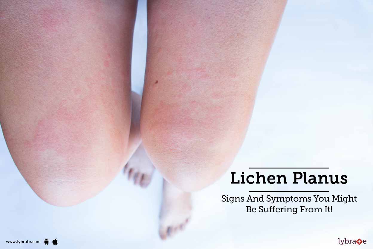 Symptoms of red flat lichen Symptoms of red flat lichen