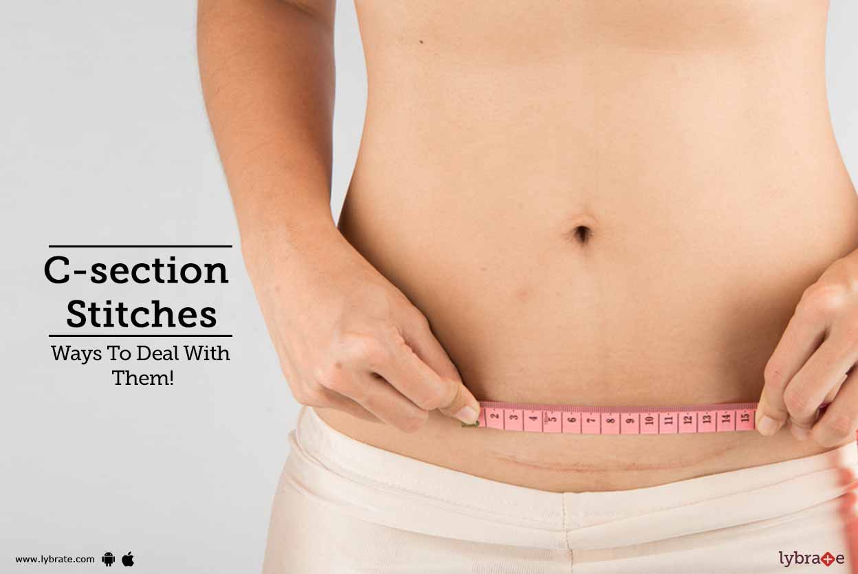 Csection Stitches Ways To Deal With Them! By Dr. Tripti Raheja