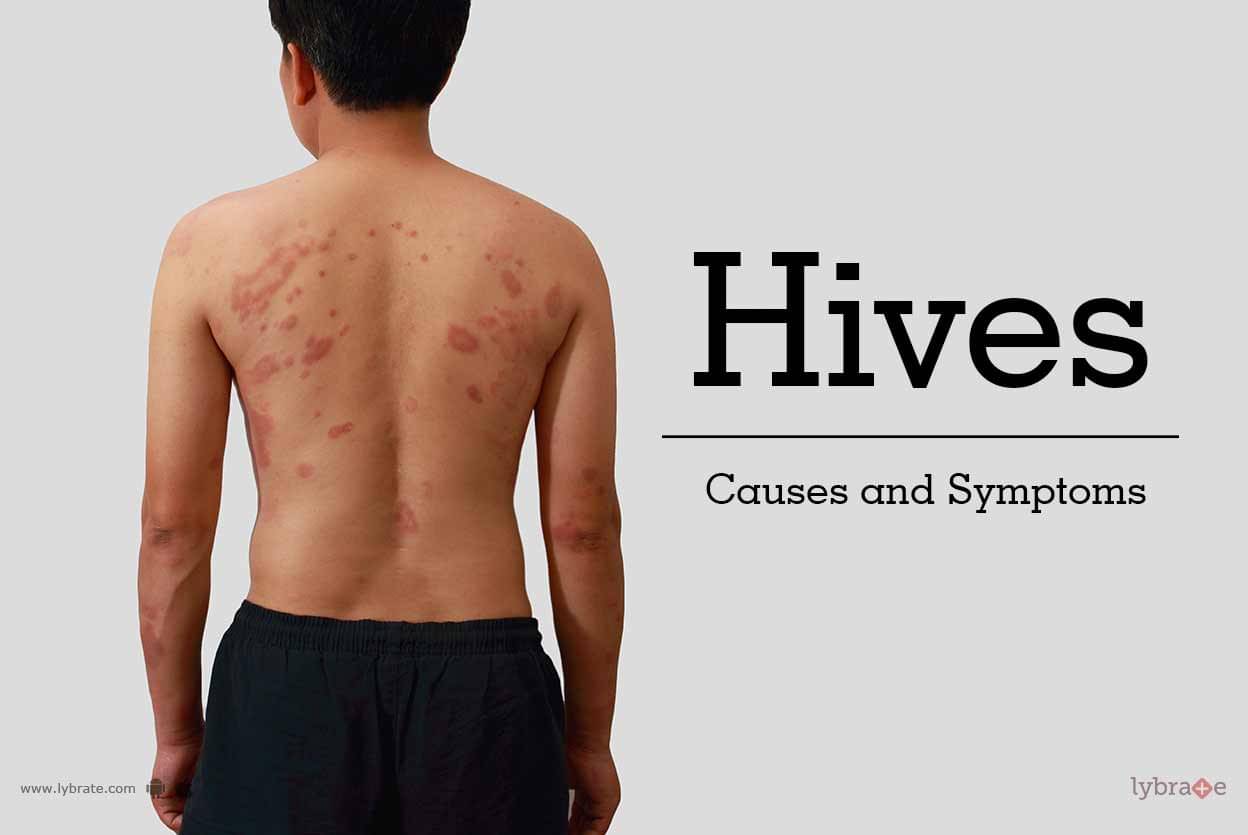 Hives: Causes And Symptoms - By Dr. Rasya Dixit | Lybrate