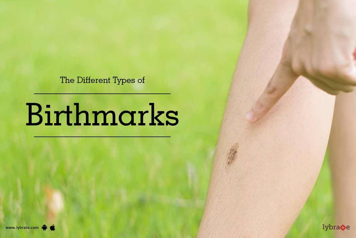 The Different Types Of Birthmarks By Dr Col Anil Goyal Lybrate