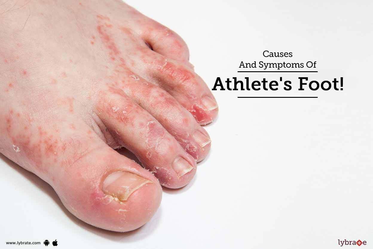 Causes And Symptoms Of Athlete's Foot! By Dr. Asma Parveen Lybrate