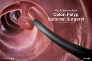 Tips To Recover From Colon Polyp Removal Surgery By Dr Avaneesh 