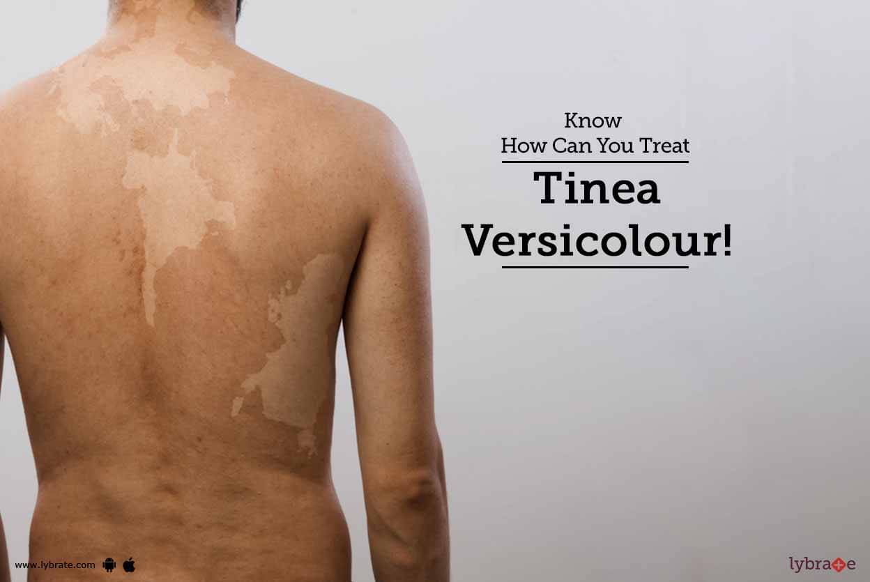 Know How Can You Treat Tinea Versicolour By Skinovate Laser