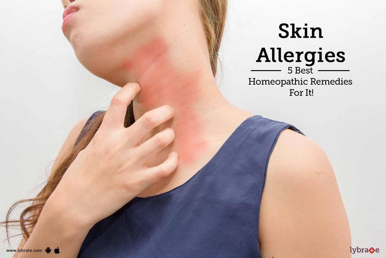 Skin Allergies 5 Best Homeopathic Remedies For It By Dr Anil Philip Lybrate