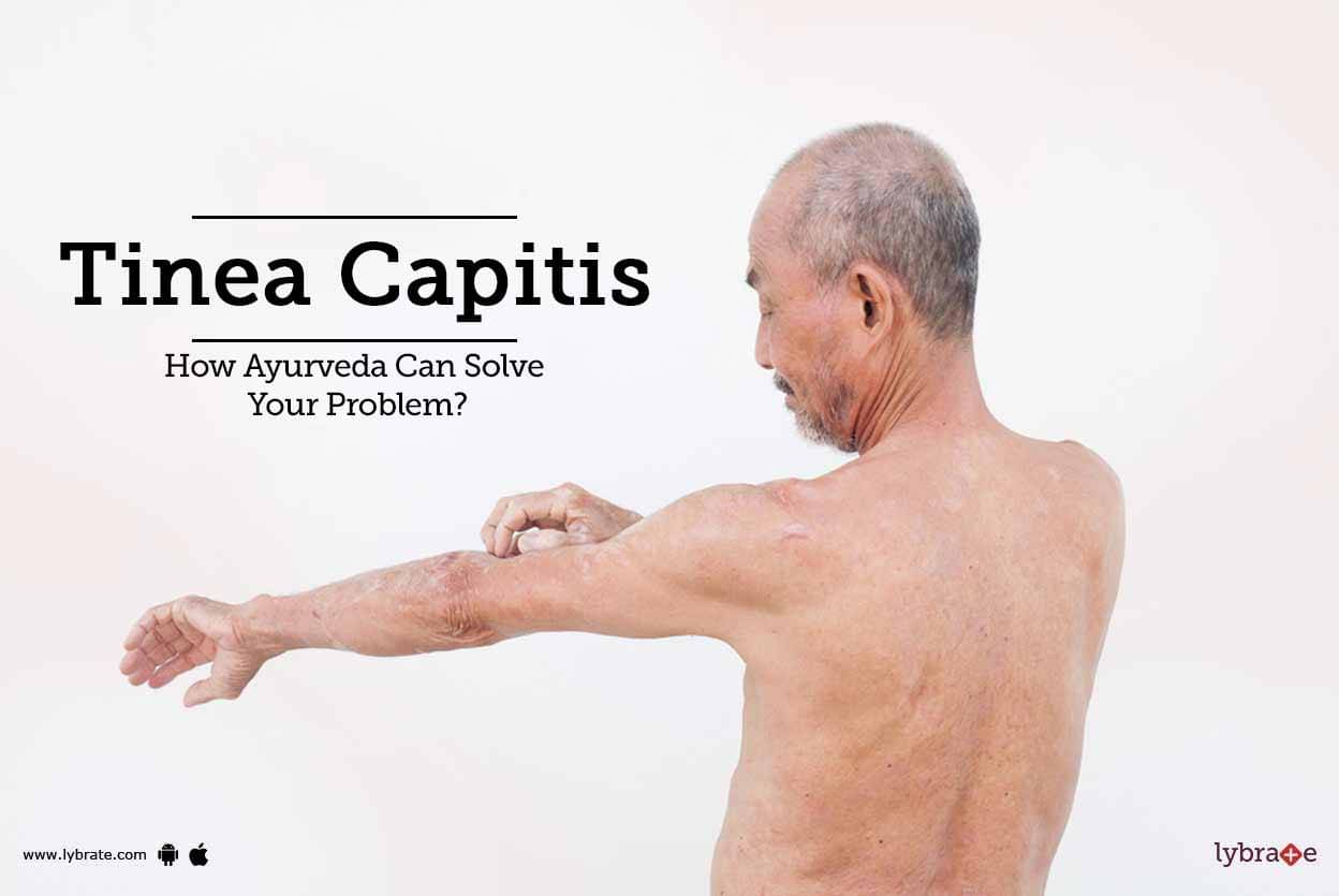 tinea-capitis-how-ayurveda-can-solve-your-problem-by-dr-rohit