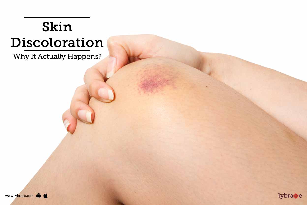 Skin Discoloration Why It Actually Happens By Dr Pooja