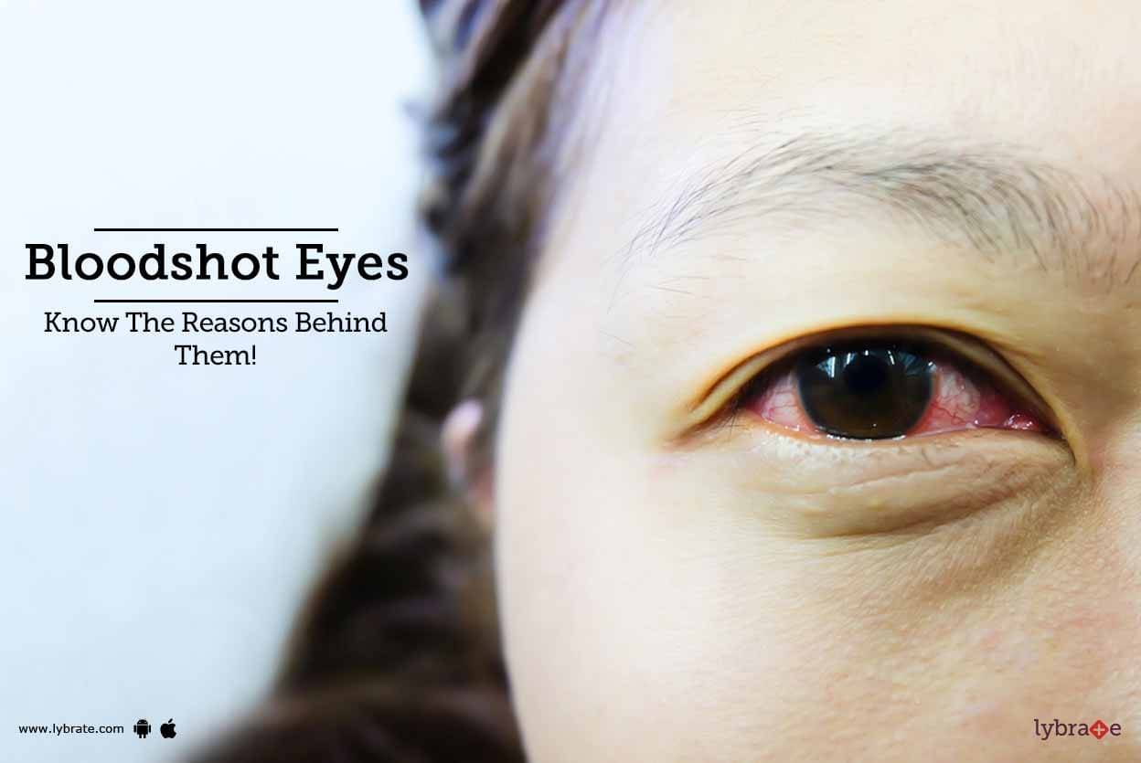 Bloodshot Eyes - Know The Reasons Behind Them! - By Dr. Rajesh Shah ...