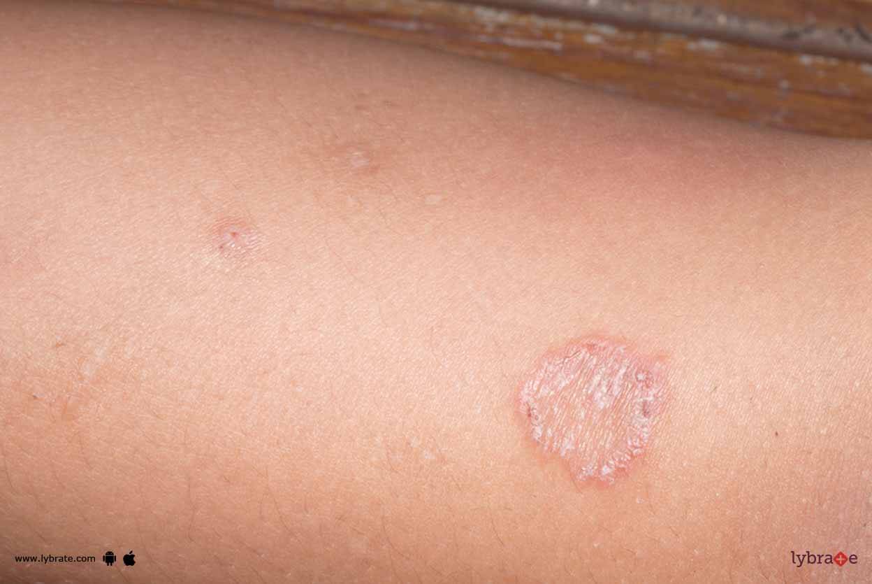 Lichen Planus - Everything About It! - By Dr. Prashant K Vaidya | Lybrate