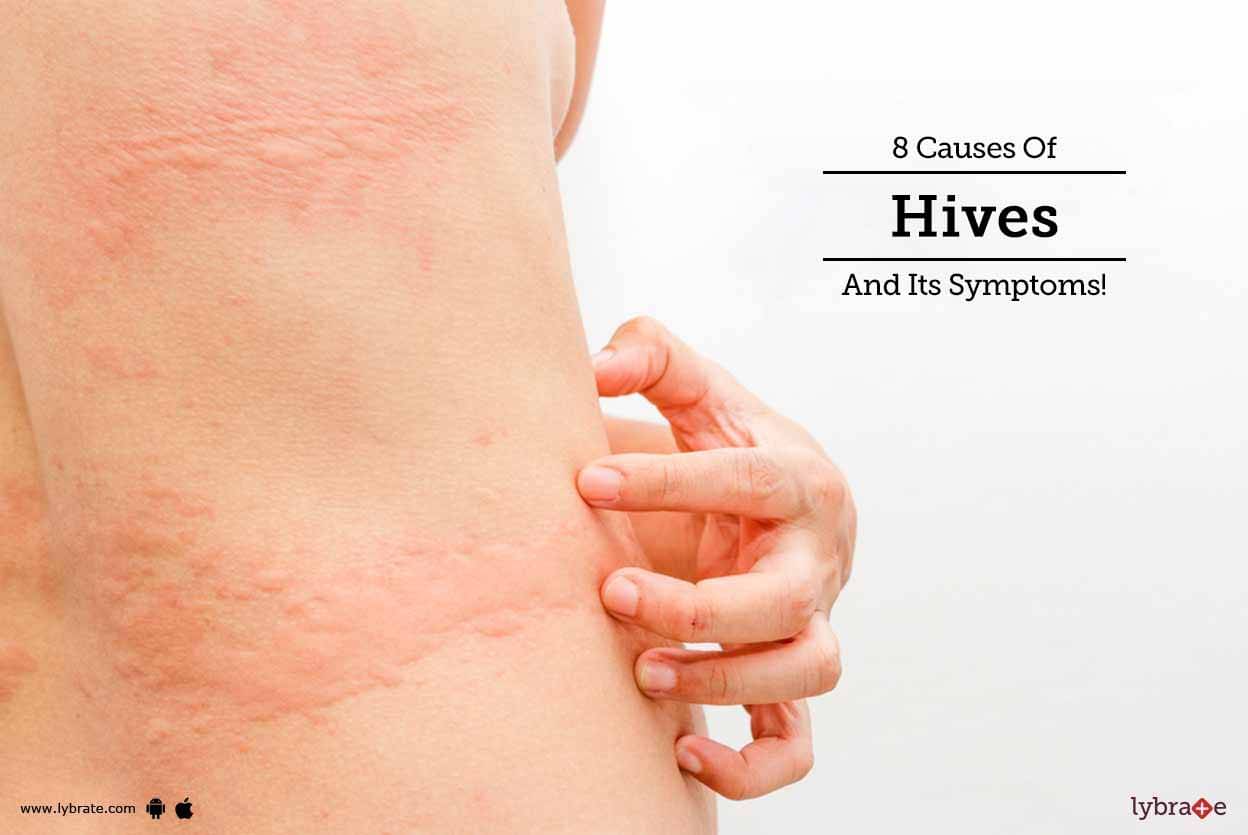 What Causes Hives And Muscle Aches