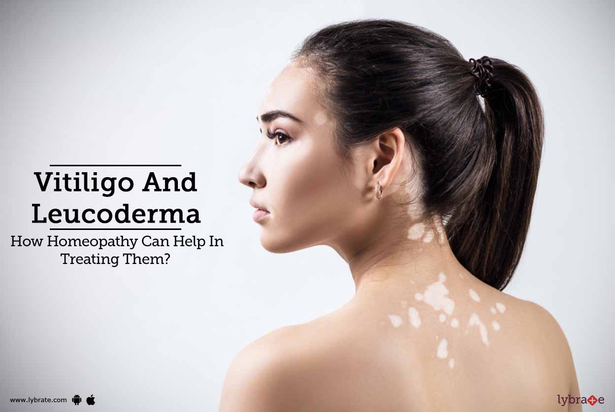 Vitiligo And Leucoderma How Homeopathy Can Help In Treating Them