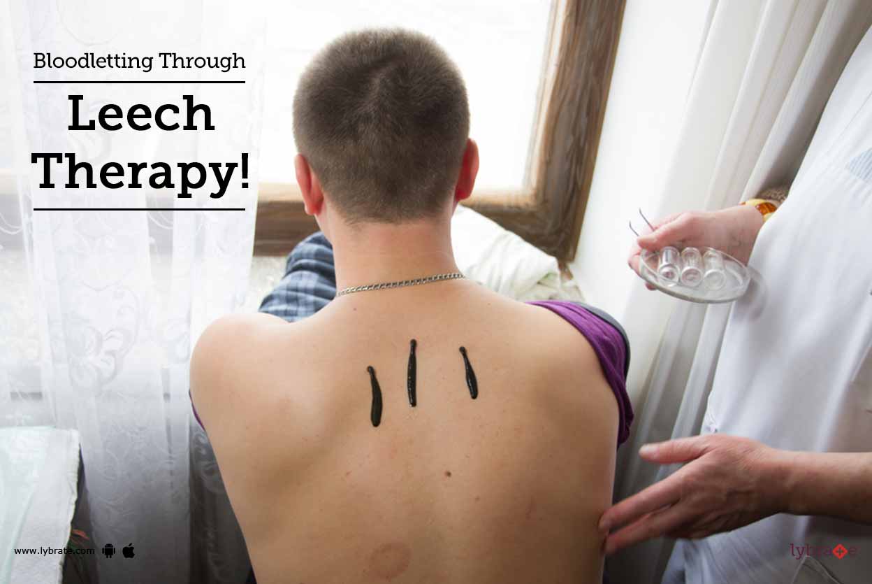 Bloodletting Through Leech Therapy! By Dr. Sharad Kulkarni Lybrate